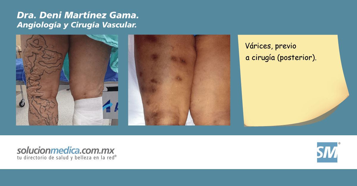 Dra. Deni Martnez Gama: Angiologa y Ciruga Vascular, Ciruga de vrices en el Hospital Mocel en Miguel Hidalgo, CdMx.