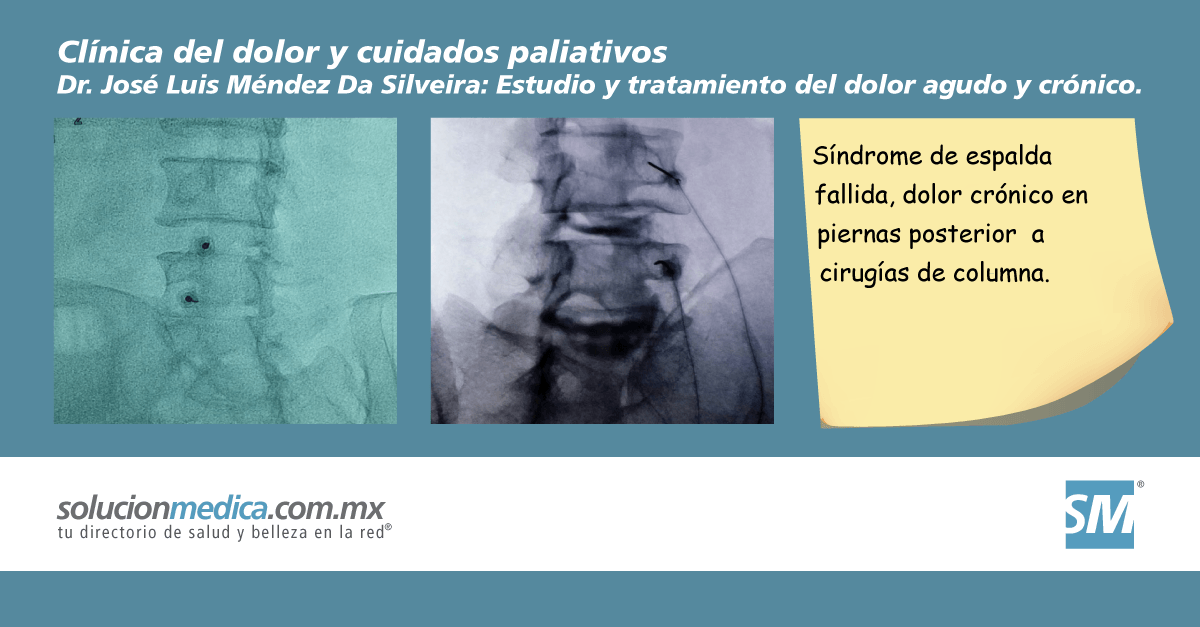 Sndrome de espalda fallida, dolor crnico en piernas posterior a cirugas de columna, atencin al paciente en Zapopan Jalisco