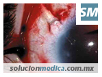 El Glaucoma, tipos de glaucoma y tratamientos | Oftalmólogos en www.solucionmedica.com.mx