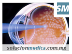 Retinopatía diabética. tratamiento para prevenir la ceguera Diabetes Mellitus fluorangiografia retiniana | www.solucionmedica.com.mx. Tu directorio de salud y belleza en la red México.